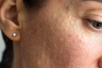 Mikroinjekcijas premium ādas atjaunošanai “RE.NEW” estētiskās medicīnas klīnikā 