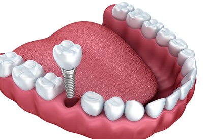 Implantologa konsultācija ar 3D rentgenu “Dental Medical” klīnikā