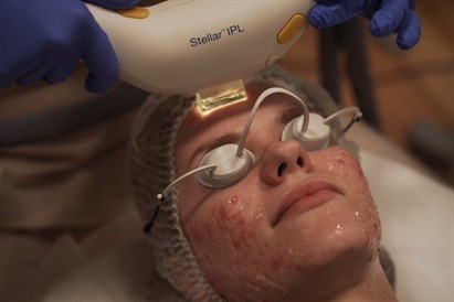 Fotorejuvenācija aknes rētu mazināšanai “RE.NEW” estētiskās medicīnas klīnikā 