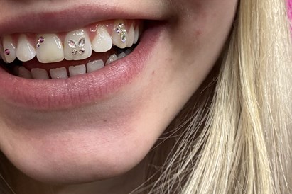 Mirdzošie “Tooth Gems” zobu kristāliņi salonā “AUCH”