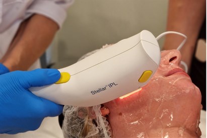 IPL fotorejuvenācija sejas ādas atjaunošanai un mirdzumam 