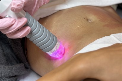 Mikroadatu radiofrekvences liftings ādas atjaunošanai