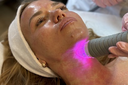 Mikroadatu radiofrekvences liftings ādas atjaunošanai