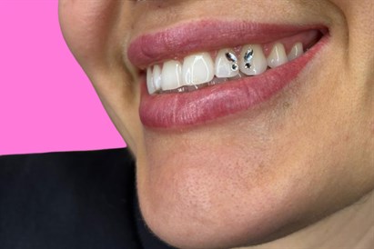 Mirdzošie “Tooth Gems” zobu kristāliņi salonā “AUCH”