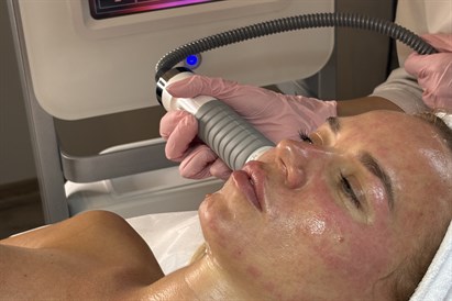 Mikroadatu radiofrekvences liftings ādas atjaunošanai